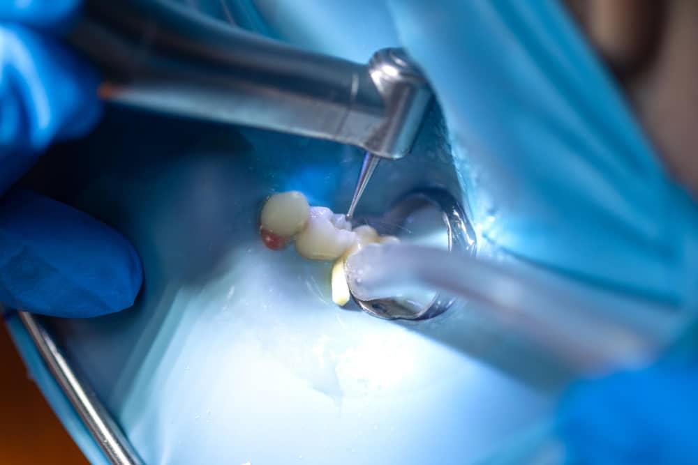 Detailed view of Tooth extraction aftercare and recovery tips from Ocean Spray Dental, Gig Harbor, WA.