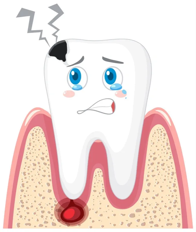 Illustration of a tooth with a cavity and decay that needs a filling