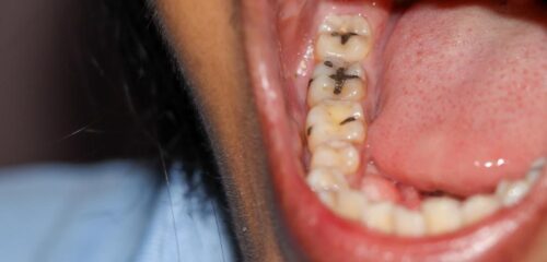 Oceanspray Dental Health